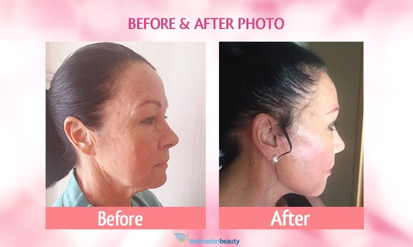 Face lift with eyelid surgery and arm lift in Thailand !! See Brigid